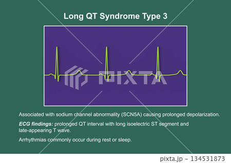 ECG in long QT syndrome type 3, 3D illustration, annotated ECG in long QT syndrome type 3, 3D illustration, annotated 134531873