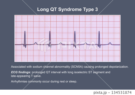 ECG in long QT syndrome type 3, 3D illustration, annotated 134531874
