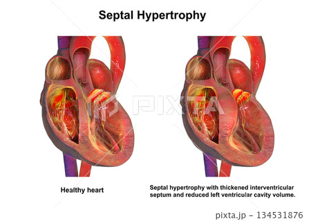 Septal hypertrophy, 3D illustration 134531876