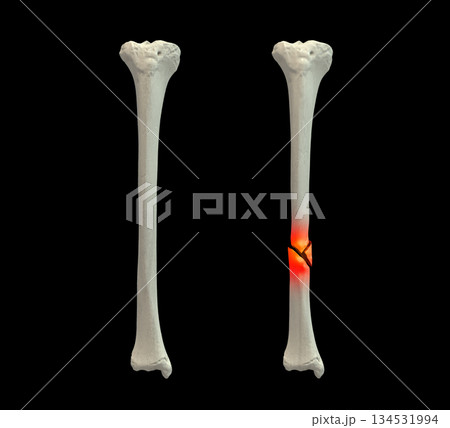 Normal tibia bone and tibia with shaft...のイラスト素材 [134531994] - PIXTA