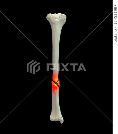 Tibia shaft fracture, 3D illustration. Shows a break in the tibial shaft, commonly caused by trauma. Clinically important for orthopedic assessment, surgical fixation, and fracture classification. Tibia shaft fracture, 3D illustration. Shows a break in the tibial shaft, commonly caused by trauma. Clinically important for orthopedic assessment, surgical fixation, and fracture classification. 134531997