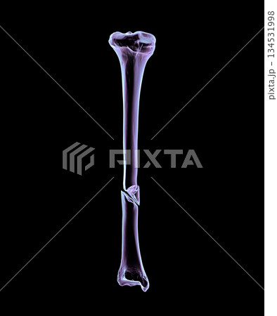 Tibia shaft fracture, 3D illustration. Shows a break in the tibial shaft, commonly caused by trauma. Clinically important for orthopedic assessment, surgical fixation, and fracture classification. Tibia shaft fracture, 3D illustration. Shows a break in the tibial shaft, commonly caused by trauma. Clinically important for orthopedic assessment, surgical fixation, and fracture classification. 134531998