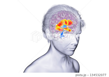 Enlarged lateral ventricles of the brain, 3D illustration 134532077
