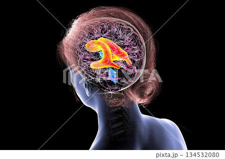 Enlarged lateral ventricles of the brain, 3D illustration Enlarged lateral ventricles of the brain, 3D illustration 134532080