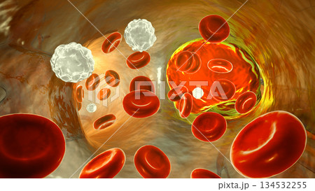 Left pulmonary embolism, 3D illustration, inside pulmonary trunk 134532255