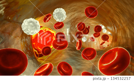 Right pulmonary embolism, 3D illustration, inside pulmonary trunk 134532257