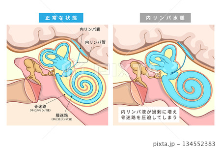 耳の中の中耳、内耳の正常な状態と内リンパ水腫やメニエール症になった時の内リンパ菅の状態 134552383