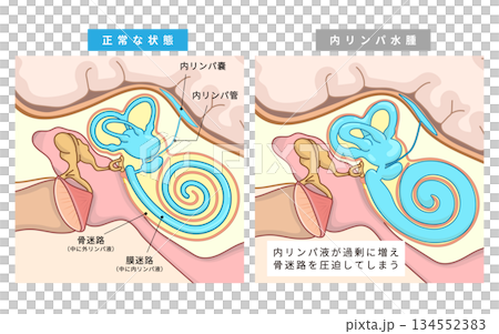 耳の中の中耳、内耳の正常な状態と内リンパ水腫やメニエール症になった時の内リンパ菅の状態 134552383