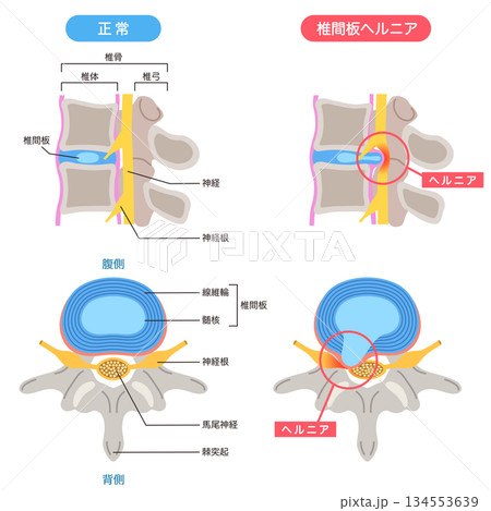 腰椎椎間板ヘルニア　椎間板の構造　腰痛 134553639