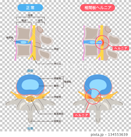 腰椎椎間板ヘルニア　椎間板の構造　腰痛 134553639