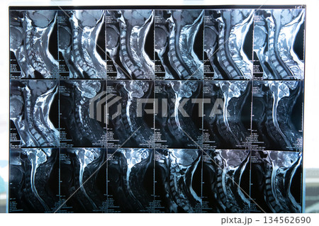 Detailed Cervical Spine MRI Scans for Medical Analysis 134562690