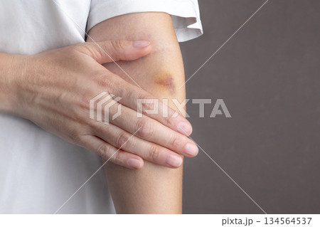 Woman hurt her hand. There is a bruise on the arm. Cropped photo, close up 134564537