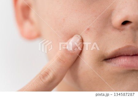 男子　10代　ニキビケア 134587287