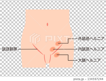 鼠径ヘルニアの種類　ヘルニア　股関節 134597244