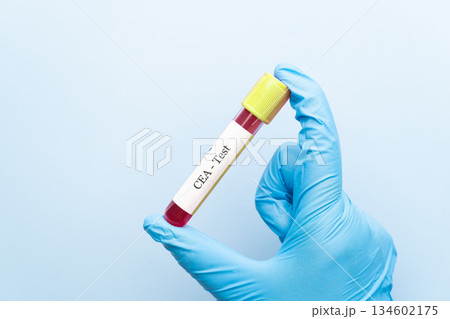 Doctor holding a test blood sample tube with CEA (Carcinoembryonic Antigen) test, tumor marker for colorectal cancer. Doctor holding a test blood sample tube with CEA (Carcinoembryonic Antigen) test, tumor marker for colorectal cancer. 134602175