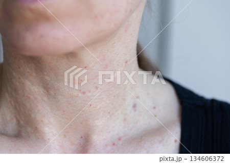 Female neck after beauty injections. Biorevitalization concept. Female neck after beauty injections. Biorevitalization concept. 134606372