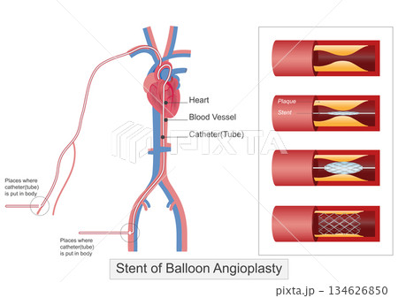 Balloon angioplasty is a medical procedure used to open narrowed. 134626850