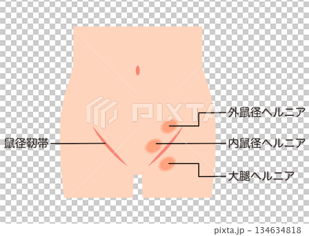 腹股溝疝氣的類型 髖關節疝 腹股溝疝氣的類型 髖關節疝 134634818