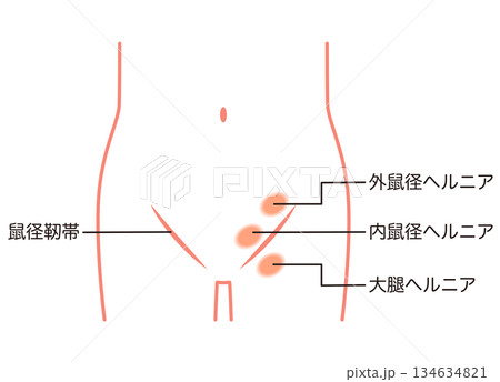 鼠径ヘルニアの種類　ヘルニア　股関節 134634821