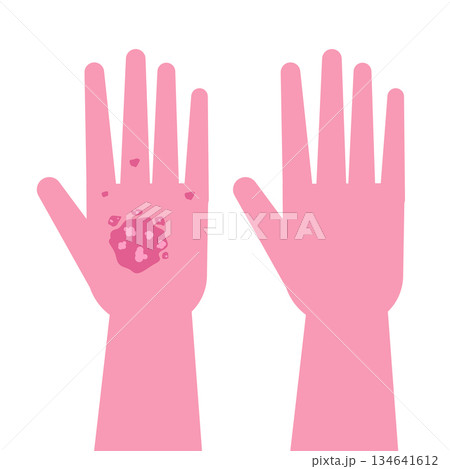 Hands with Psoriasis before and after treatment. Vector illustration Hands with Psoriasis before and after treatment. Vector illustration 134641612