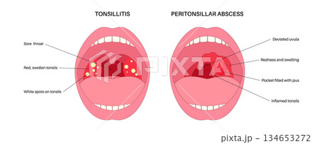 Peritonsillar abscess and tonsillitis 134653272