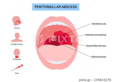 Peritonsillar abscess poster Peritonsillar abscess poster 134653276