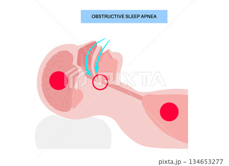 Obstructive sleep apnea Obstructive sleep apnea 134653277