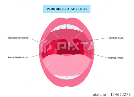 Peritonsillar abscess poster Peritonsillar abscess poster 134653278