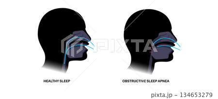 Obstructive sleep apnea 134653279