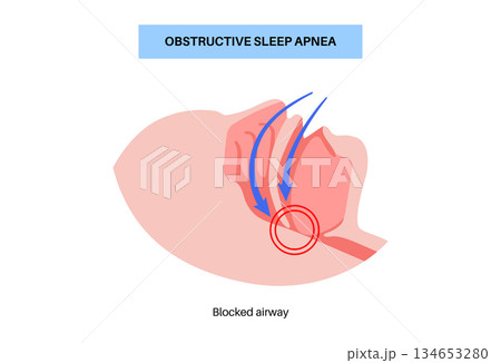 Obstructive sleep apnea 134653280