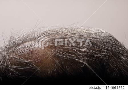 頭の切り傷　ケガ　七日目抜糸した 134663832