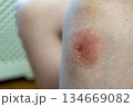 Skin rash on caucasian boy with dry texture and redness 134669082