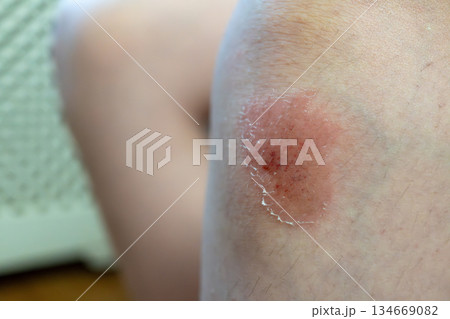 Skin rash on caucasian boy with dry texture and redness 134669082
