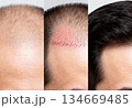 Hair restoration transformation: before, during, and after hair transplant journey for confidence and renewal 134669485