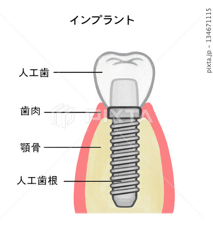 インプラントの構造のイラスト - 1 134671115