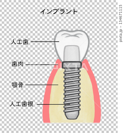 植入體結構示意圖 - 1 134671115