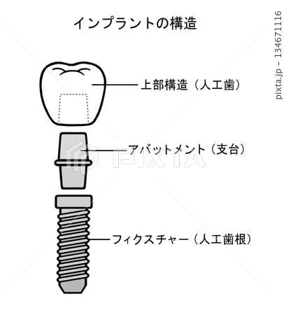 インプラントの構造のイラスト - 2 インプラントの構造のイラスト - 2 134671116