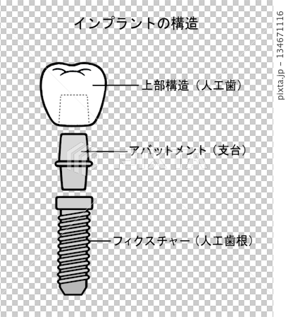 Illustration of implant structure - 2 134671116
