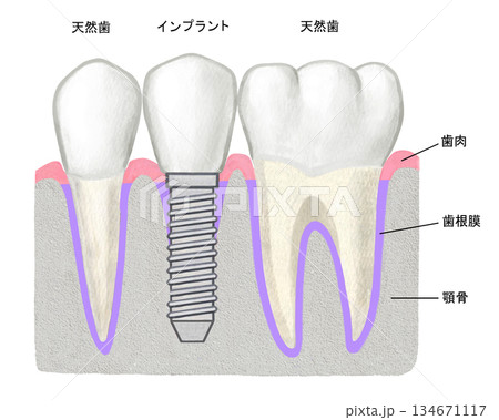 インプラントの歯と天然歯 134671117