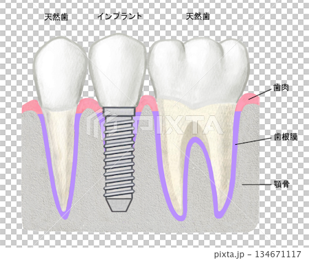 インプラントの歯と天然歯 134671117