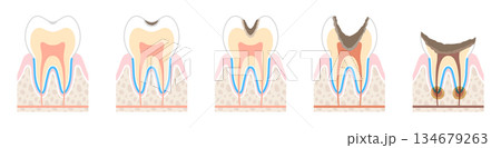 虫歯の進行度の図解 134679263