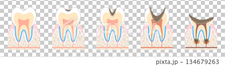 虫歯の進行度の図解 134679263