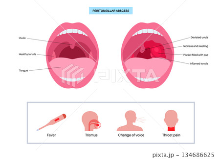 Peritonsillar abscess poster Peritonsillar abscess poster 134686625