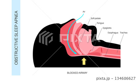 Obstructive sleep apnea 134686627