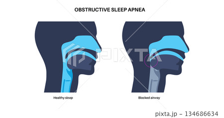 Obstructive sleep apnea Obstructive sleep apnea 134686634