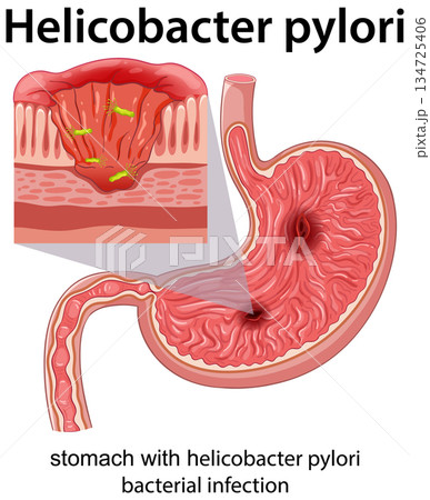 Stomach Cross-Section Showing Helicobacter Pylori Bacterial Infection 134725406
