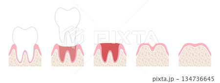 抜歯後の回復過程の図解　文字なし 134736645