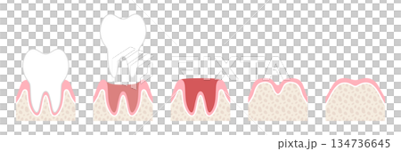 抜歯後の回復過程の図解　文字なし 134736645