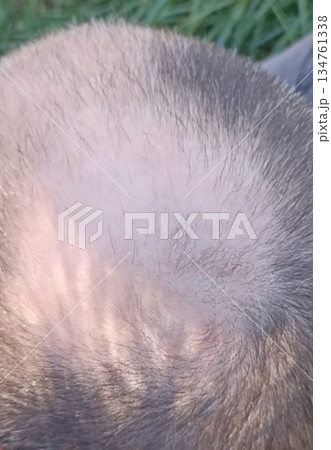 A close-up reveals a balding head with noticeable thinning hair and a receding hairline, highlighting concerns about hair loss and aging. Ideal for healthcare or lifestyle topics. 134761338