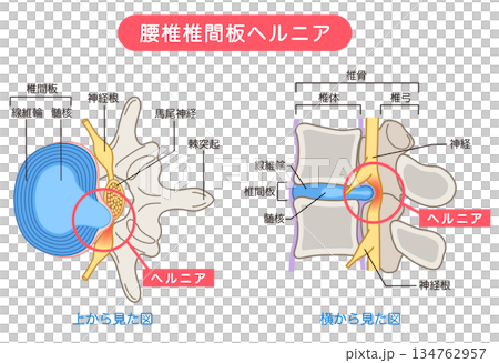 Lumbar disc herniation, structure of the intervertebral disc, lower back pain Lumbar disc herniation, structure of the intervertebral disc, lower back pain 134762957